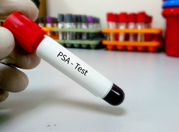 Blood sample for PSA (prostate specific antigen) test, diagnosis of prostate cancer stock photo
