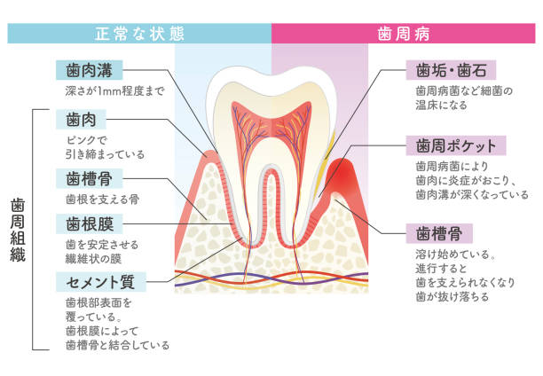 vergleichsdiagramm von parodontitis und normalzustand - human teeth dental hygiene dentist office human mouth stock-grafiken, -clipart, -cartoons und -symbole