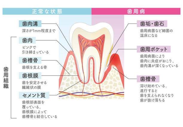 illustrations, cliparts, dessins animés et icônes de diagramme de comparaison de la maladie parodontale et de l’état normal - human teeth dental hygiene dentist office human mouth