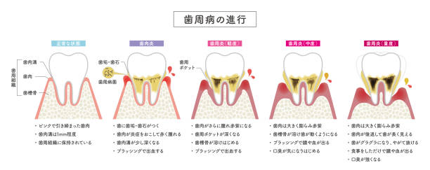 illustrations, cliparts, dessins animés et icônes de illustration de la progression de la maladie parodontale - human teeth dental hygiene dentist office human mouth