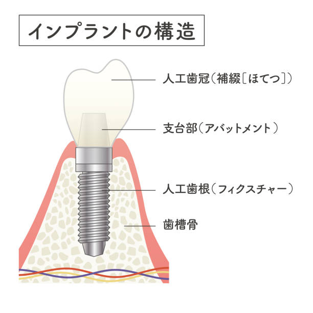 ilustrações de stock, clip art, desenhos animados e ícones de implant structural illustration - human teeth dental hygiene anatomy diagram