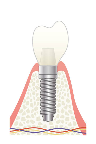 ilustrações de stock, clip art, desenhos animados e ícones de implant structural illustration - human teeth dental hygiene anatomy diagram