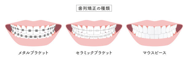 illustration des kieferorthopädischen typensatzes - human teeth dental hygiene dentist office human mouth stock-grafiken, -clipart, -cartoons und -symbole