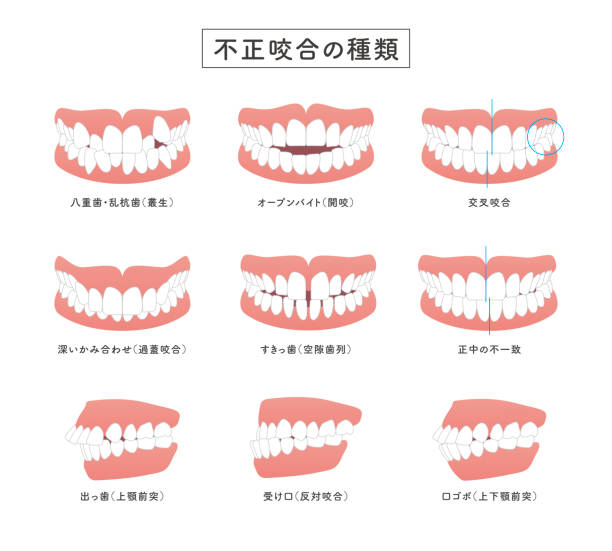 illustrazioni stock, clip art, cartoni animati e icone di tendenza di illustrazione del set di tipi di malocclusione - human teeth dental hygiene dentist office human mouth
