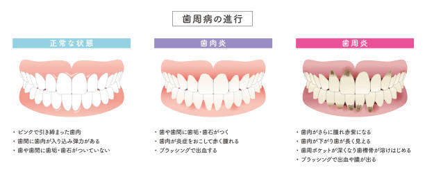 ilustrações de stock, clip art, desenhos animados e ícones de periodontal disease progression illustration set - human teeth dental hygiene anatomy diagram