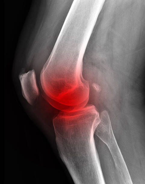 x-ray z bolesne stawu kolanowego. - x ray human knee orthopedic equipment human bone zdjęcia i obrazy z banku zdjęć