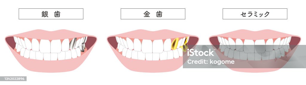 ゴールド歯銀歯セラミックイラスト - 歯のロイヤリティフリーベクトルアート