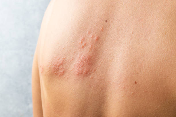 hautinfiziert herpes zoster virus. herpesvirus am körper. urtikaria hautausschlag. atopische dermatitis am körper - raised skin stock-fotos und bilder