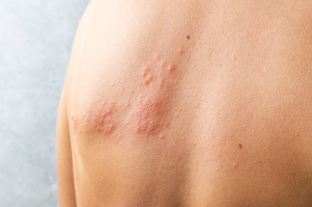 Skin infected Herpes zoster virus. Herpes Virus on body. urticaria rash. atopic dermatitis on body Skin infected Herpes zoster virus. Herpes Virus on body. urticaria rash. atopic dermatitis on body. pox stock pictures, royalty-free photos & images
