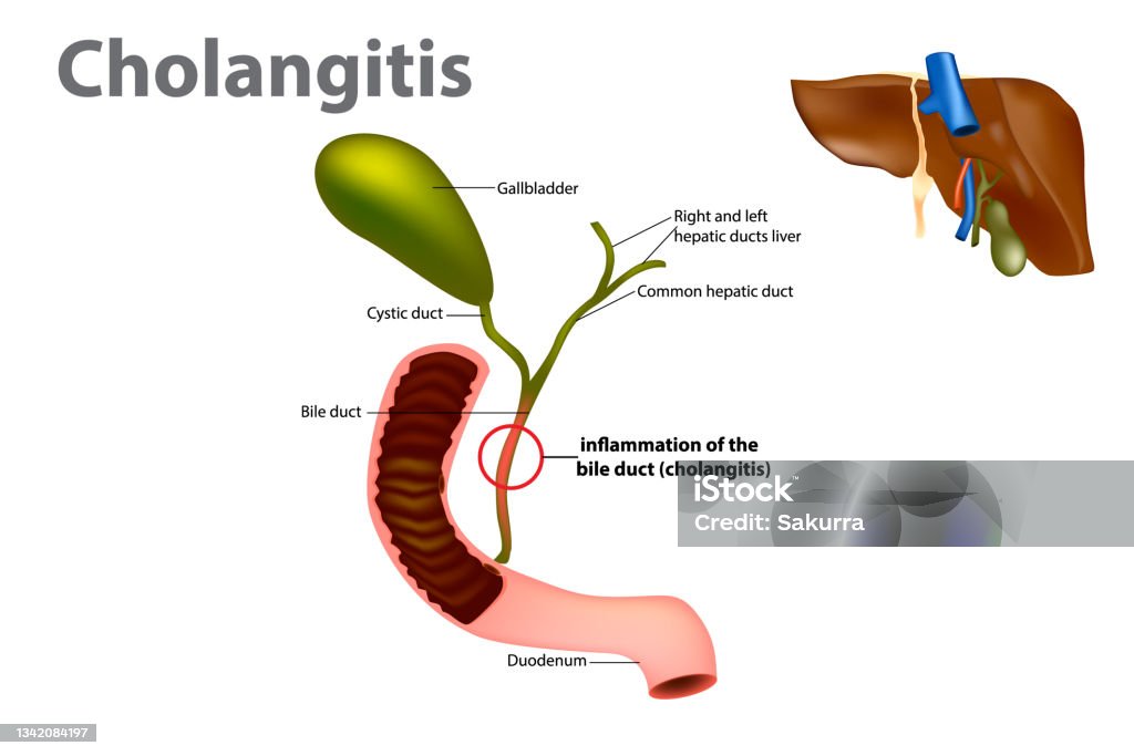 Cholangitis Rash Bakterielle Cholangitis Behandlung – TDQPH