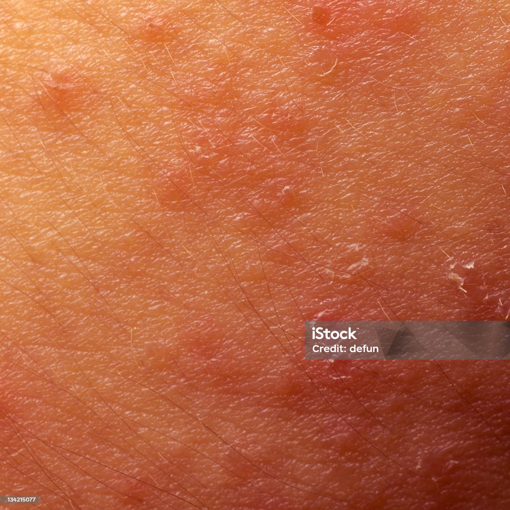 eczema atopic 皮膚炎の症状お肌の質感 - アトピー性皮膚炎のロイヤリティフリーストックフォト