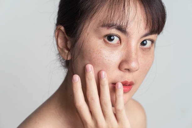 Young Asian woman worry with freckle on face and hand gently touching cheek applying skincare cosmetics treatment. stock photo