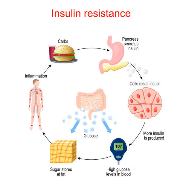 Insulin resistance. pathological condition Insulin resistance. pathological condition in which cells fail to respond normally to the hormone insulin. Insulin and glucose cycle. blood and guts stock illustrations