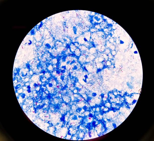 istock Sputum smear AFB stain microscopic 100x show plenty of Macrobacterium Tuberculosis bacteria. 1342438673