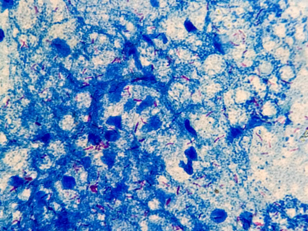 frotis de esputo afb tinción microscópica 100x muestra un montón de bacterias macrobacterium tuberculosis. - tinción acidorresistente fotos fotografías e imágenes de stock