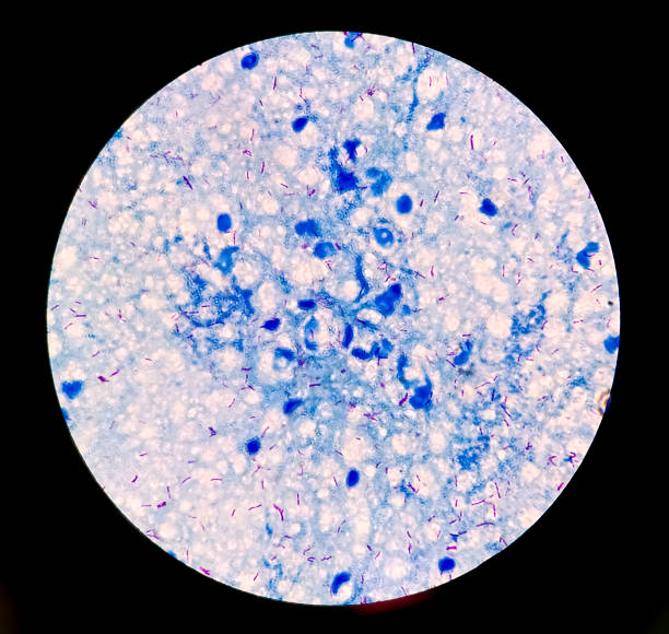 frotis de esputo afb tinción microscópica 100x muestra un montón de bacterias macrobacterium tuberculosis. - tinción acidorresistente fotos fotografías e imágenes de stock