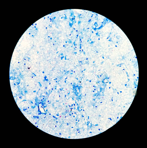 frotis de esputo afb tinción microscópica 100x muestra un montón de bacterias macrobacterium tuberculosis. - tinción acidorresistente fotografías e imágenes de stock
