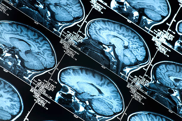 MRI Brain Scan showing multiple images of head and skull stock photo