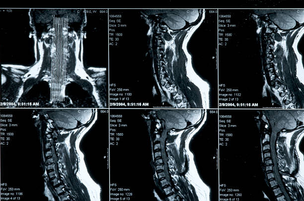 Xray of human neck (broken) stock photo