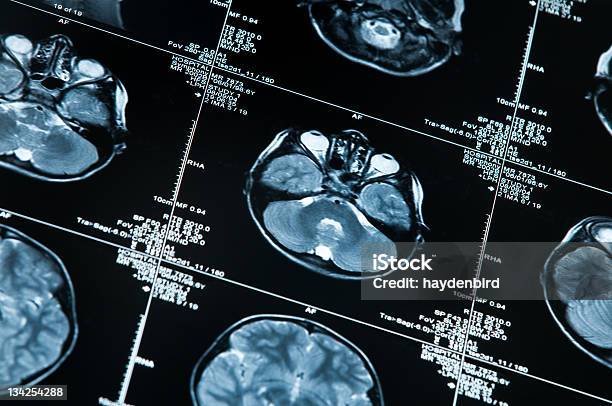 Mri Scan Mit Gehirn Mehrere Bilder Von Kopf Und Totenkopf Stockfoto und mehr Bilder von Anatomie