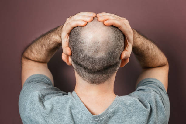 complexe de doute de soi et d’infériorité. un homme adulte chauve attrape sa tête avec ses mains. vue arrière. fond brun. le concept d’alopécie et de calvitie - balding photos et images de collection