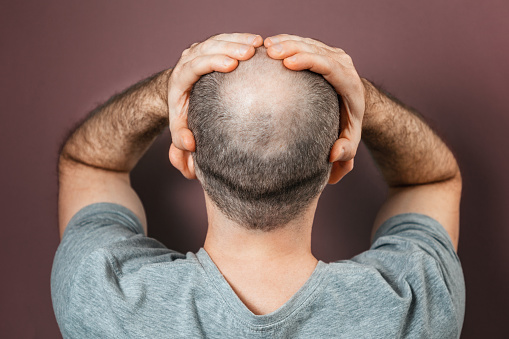 Self-doubt and inferiority complex. Baldy adult man grabs his head with his hands. Rear view. Brown background. The concept of alopecia and baldness.