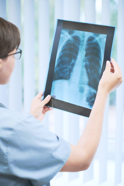 widok przez ramię lekarza w peelingach wskazujących na obecność zapalenia płuc podczas znieczulenia płuc obraz rentgenowski - x ray chest human lung rib cage zdjęcia i obrazy z banku zdjęć