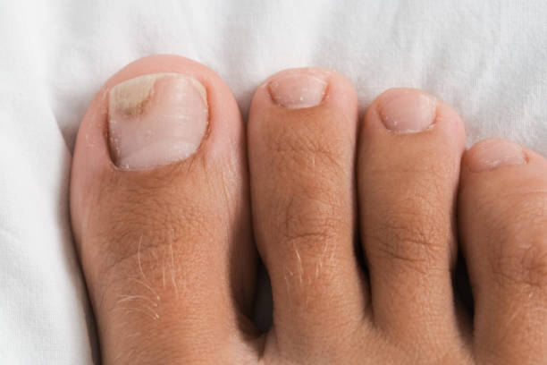 pé descalço com oniolise em uma unha do pé depois de danificar com sapatos apertados ou usar gel-laca - podiatry chiropody toenail human foot - fotografias e filmes do acervo