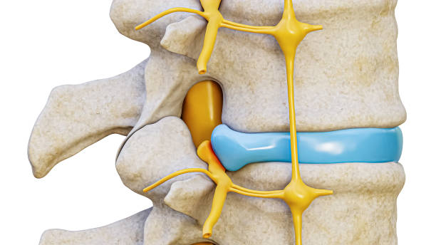 hernie discale avec compression du nerf spinal illustration de rendu 3d vue latérale isolée sur fond blanc. lésion de l’épine dorsale ou de la colonne vertébrale, anatomie, concepts médicaux, scientifiques. - spinal nerve photos et images de collection