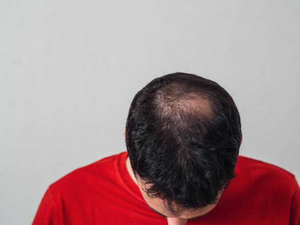 istock A sad man with baldness with copy space. Top view 1343121014