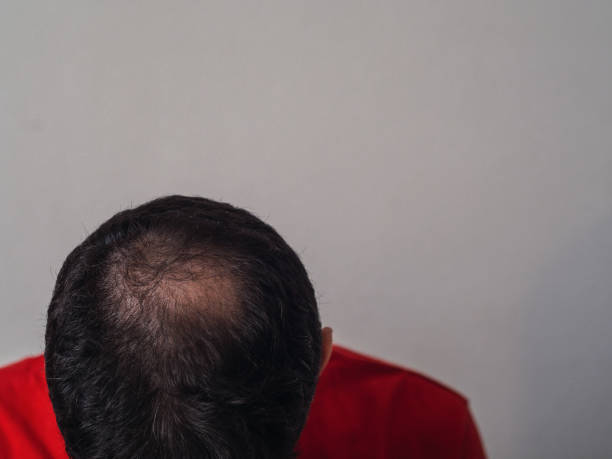 istock A sad man with baldness with copy space. Top view 1343123898