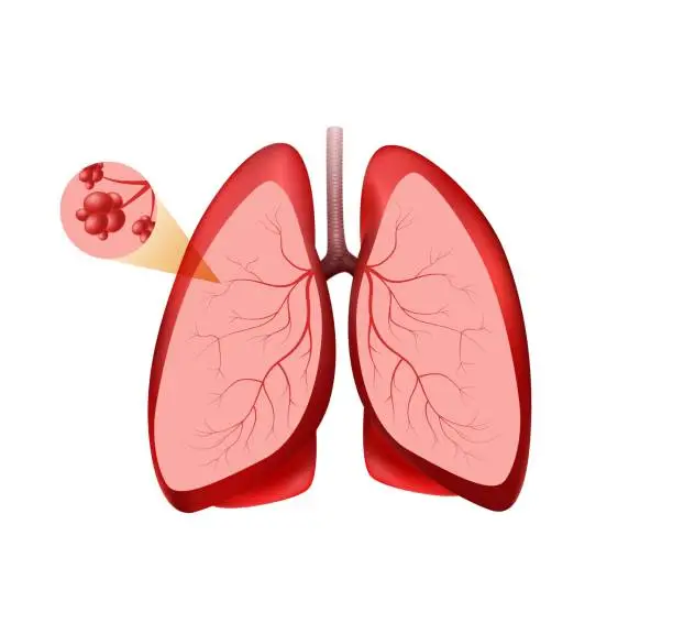 Vector illustration of Location pulmonary alveoli clipart. Pink lungs with red vessels and healthy bronchial vesicles good breathing.