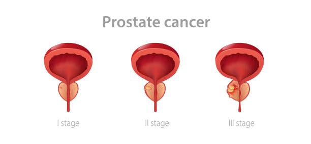 illustrations, cliparts, dessins animés et icônes de stades du cancer de la prostate. la perturbation de la glande masculine avec sa croissance en tumeur maligne a altéré la fonction de reproduction. - prostate gland