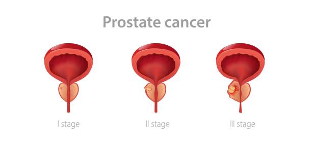 Stages prostate cancer. Disruption of male gland with its growth into malignant tumor impaired reproductive function. Stages prostate cancer. Disruption of male gland with its growth into malignant tumor impaired reproductive function and blockage vector urethra. prostate gland stock illustrations