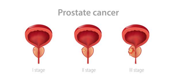 Stages prostate cancer. Disruption of male gland with its growth into malignant tumor impaired reproductive function. Stages prostate cancer. Disruption of male gland with its growth into malignant tumor impaired reproductive function and blockage vector urethra. phallic object stock illustrations