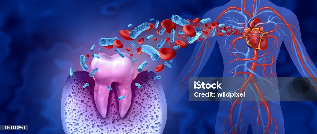 Tooth Decay Disease Tooth decay and heart disease as an unhealthy molar with periodontitis due to poor oral hygiene health problem as a bacteria infection in the blood as a concept with inflammation as a 3D illustration on a blue background. Dental Health Stock Photo