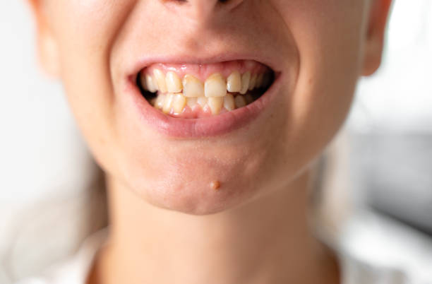 Crooked and yellow teeth. Woman has malocclusion. Adult orthodontics problem and treatment. Somatology medicine stock photo