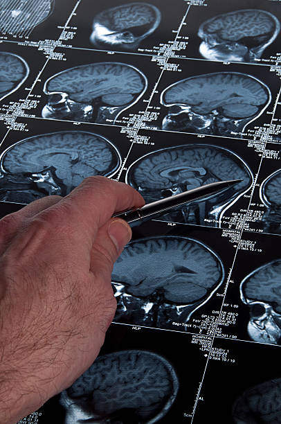 exame de ressonância magnética da cabeça e cérebro crânio com mão a apontar - corpus striatum imagens e fotografias de stock
