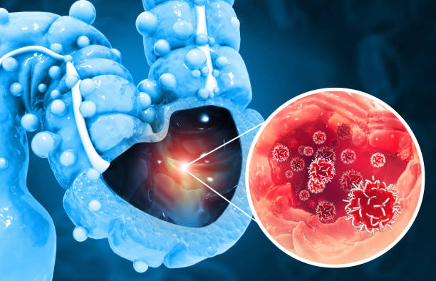 istock Colon cancer. Cancer attacking cell. Colon disease concept. 3d illustration 1343477218