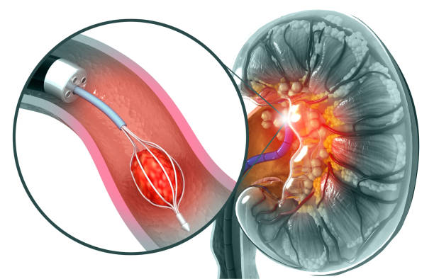 istock Kidney stone removing concept. 3d illustration 1343477434