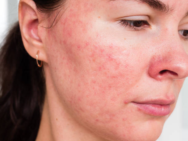 rosacea papulopustular, close-up da bochecha do paciente - as consequências do uso prolongado de uma máscara - rosácea irritação cutânea - fotografias e filmes do acervo