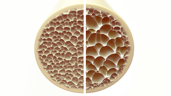 hueso sano y hueso osteoporosis - comparación directa - 3D Rendering photo