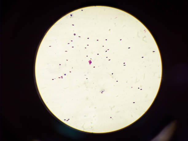 cytopatologia tkanka tworzy piersi, mikroskopijny obraz ziarniniakowego zapalenia sutka. - cytopatologia zdjęcia i obrazy z banku zdjęć