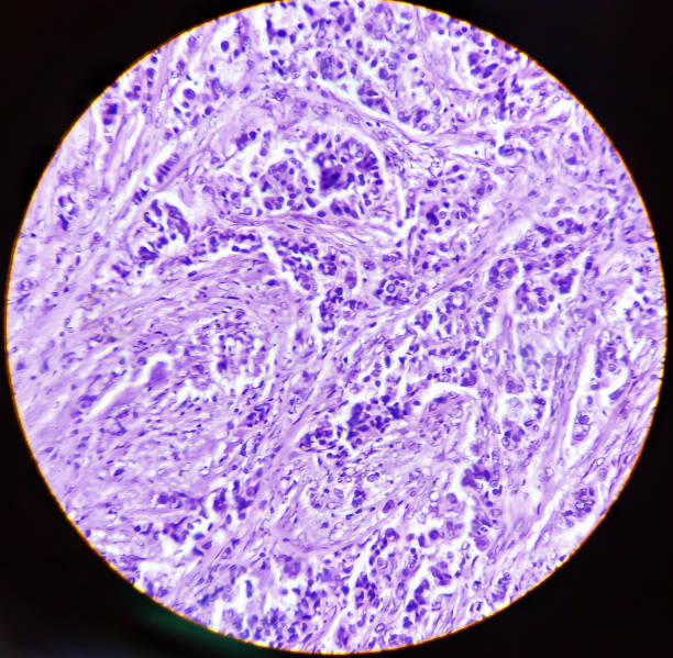 на фотофотографии показана аденокарцинома желчного пузыря. рак желчного пузыря, хорошо дифференцированная аденокарцинома - cancer cell flash стоковые фото и изображения