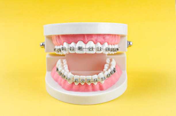 modelo de diente con brackets dentales de alambre metálico - corrector fotografías e imágenes de stock