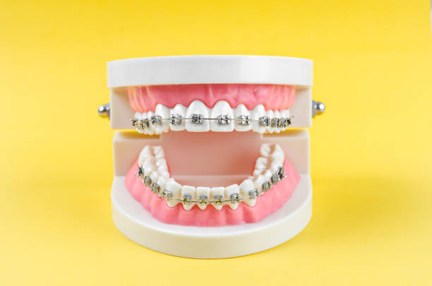 tooth model with metal wire dental braces tooth model with metal wire dental braces and equipment on yellow background human teeth photos stock pictures, royalty-free photos & images