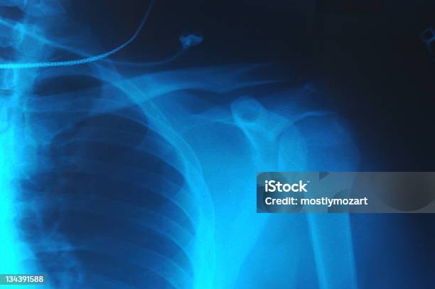 La Radiografía Del Hombro Foto de stock y más banco de imágenes de Hombro - Hombro, Imagen de rayos X, Brazo fracturado