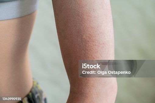 istock follicular hyperkeratosis is located on the person's arm 1343990935