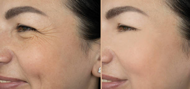woman eyes wrinkles before and after treatment woman eyes wrinkles before and after treatment botox before and after stock pictures, royalty-free photos & images