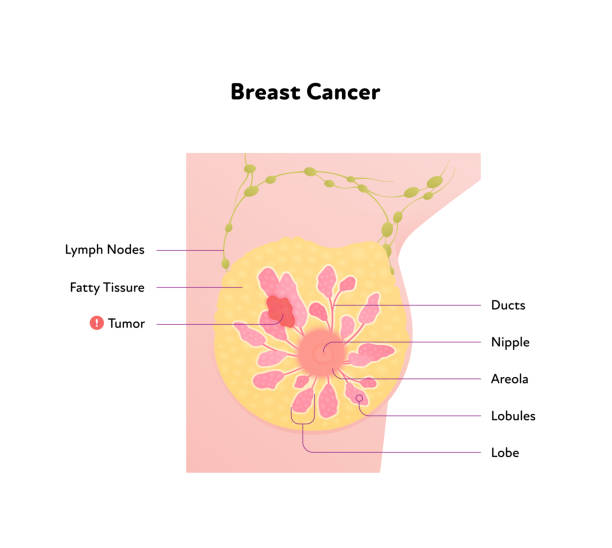 diagram anatomii ludzkiego raka piersi. wektorowa płaska ilustracja medyczna. wykres przekroju widoku z przodu z tekstem i komórkami nowotworowymi wyizolowanymi na białym tle. projektowanie dla służby zdrowia, nauki, edukacji. - gland lobule stock illustrations